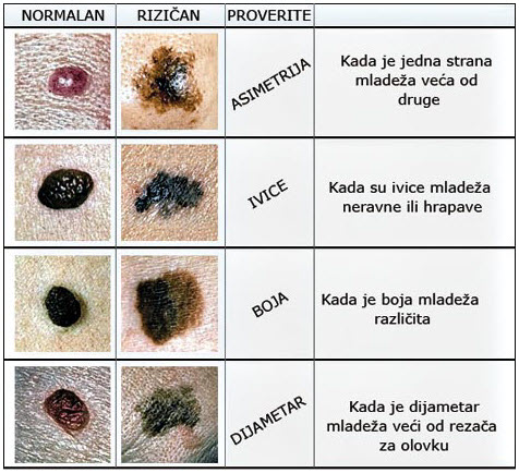 ABCDE simptomi melanoma