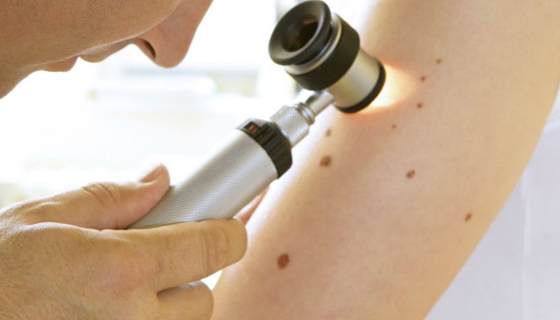 Melanoma-diagnosis-