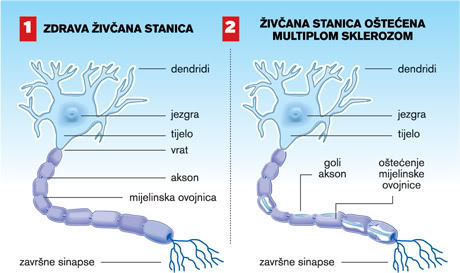 Multipla skleroza 2