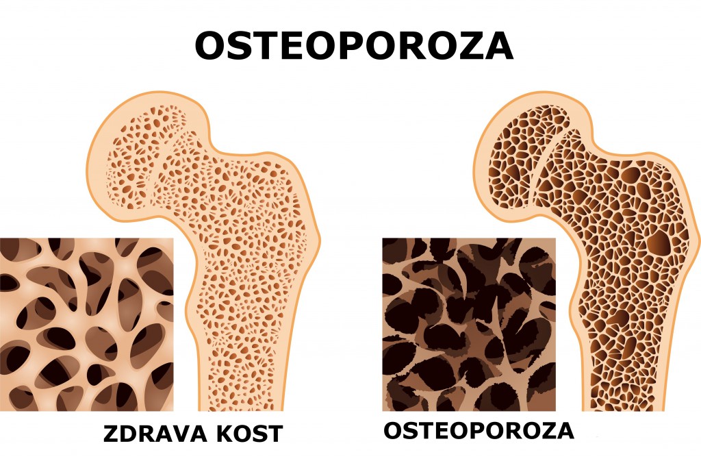 Osteoporoza