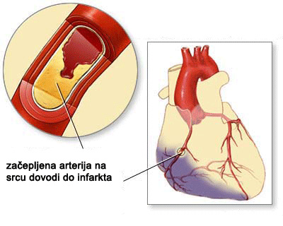 Srčani udar (infarkt miokarda) – uzroci, simptomi i liječenje | Zdravlje srca - Kreni zdravo!